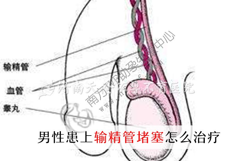 深圳助孕产子费用:男性输精管堵塞的治疗。